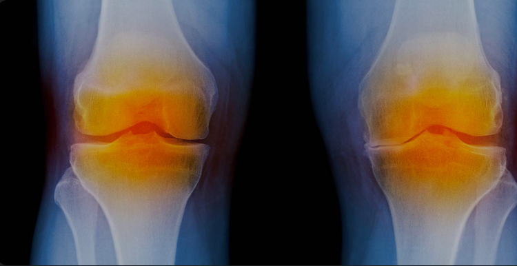 Knee Replacement Surgery in Jaipur | Modern Solutions for Joint Pain