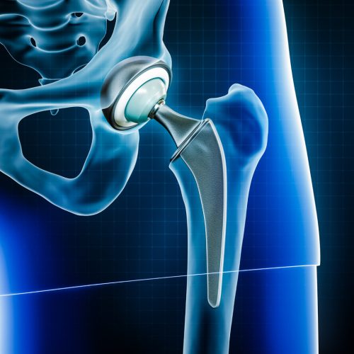 best hip replacement surgeon in Chandigarh