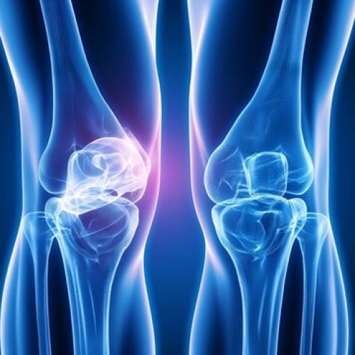 Trusted FT-3D Knee Replacement Surgeon in Chandigarh for Painless Recovery
