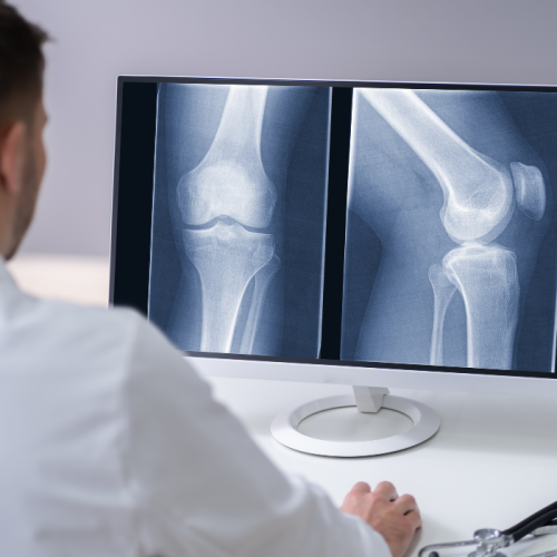 How to Save on FT 3D Knee Resurfacing Costs in India