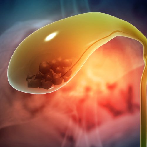 Top Gallbladder Stone Treatment Options in Zirakpur