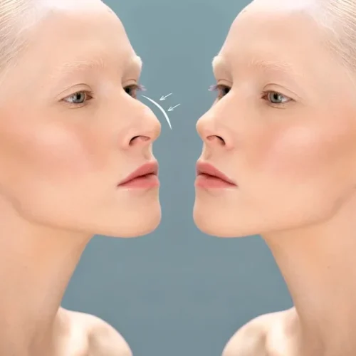 Rhinoplasty in Chandigarh