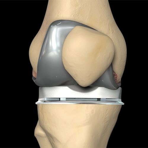 Is it worthwhile to invest in 3D knee resurfacing in India? Cost Analysis