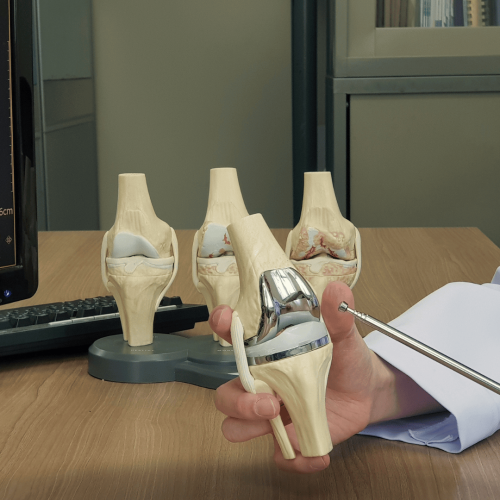 <strong>Revolutionizing Knee Care: Robotic Knee Replacement Surgery in Mumbai</strong>