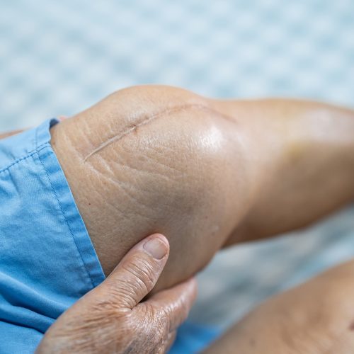 Knee Replacement Surgery Goa
