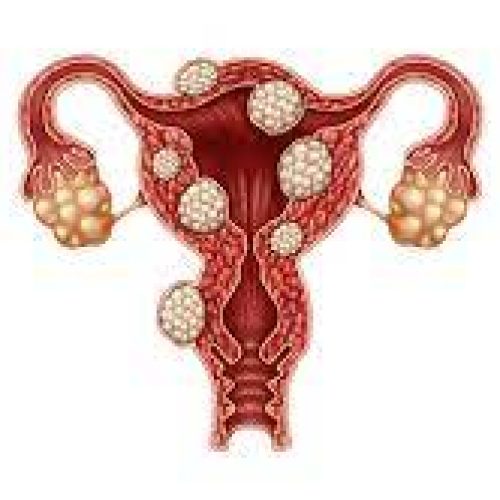 <strong>Fibroids: Understanding the Causes and Options for Treatment</strong>