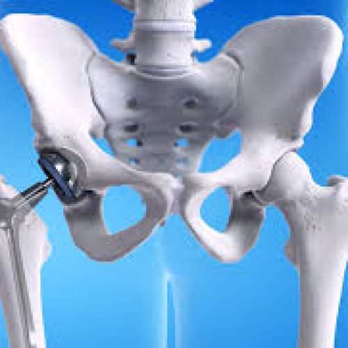 Best hip Replacement Surgeon in Chandigarh