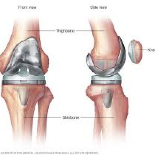 Experience the Best Partial Knee Replacement in Mumbai