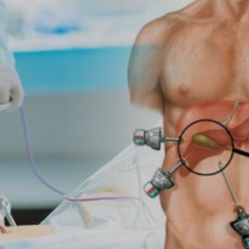 laparoscopic surgery in Mohali