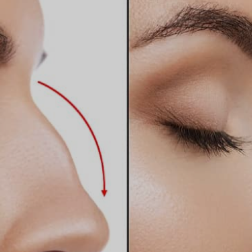 rhinoplasty in chandigarh 