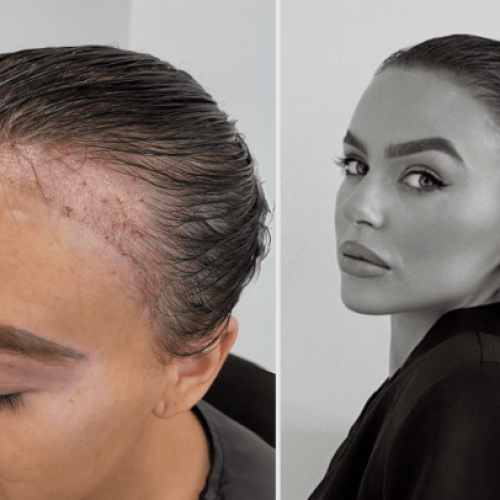 Best Hair Transplant in Chandigarh