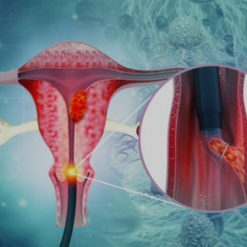 Uterus Removal Expert in Mohali