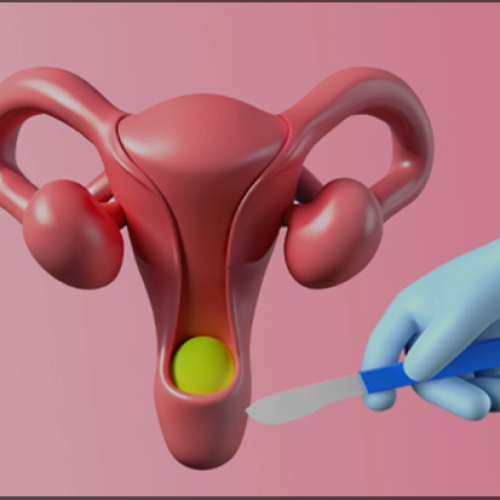 Uterus Removal Experts in Mohali Safe and Advanced Surgical Care
