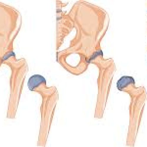 Top Orthopedic Specialist for Hip Replacement in Chandigarh