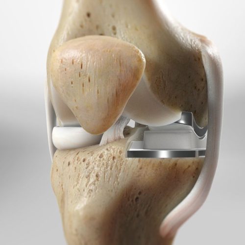 Walk Taller: How to Choose a Knee Replacement Surgeon