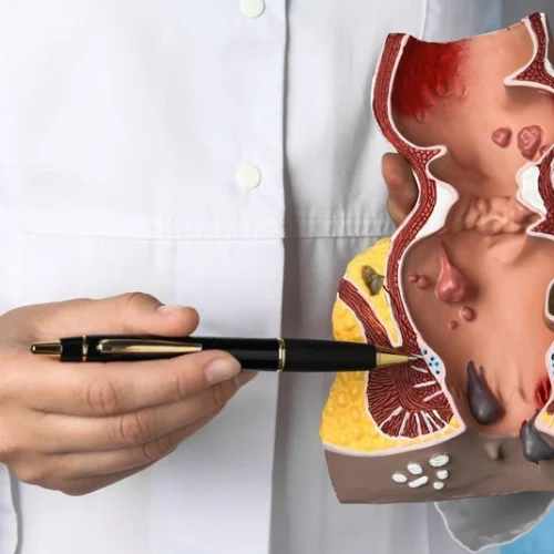 Best Piles Treatment Doctor in Panchkula