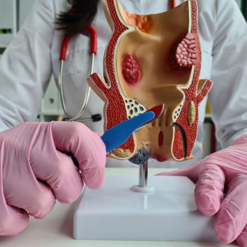 piles treatment in Chandigarh