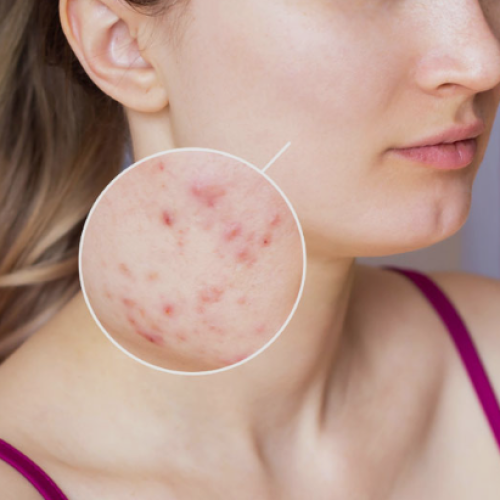 acne scar treatment in Chandigarh