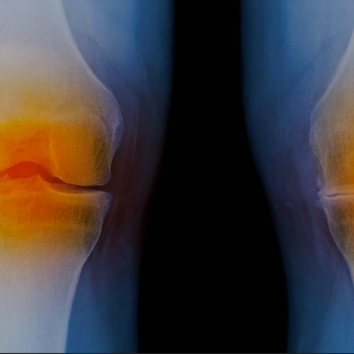 knee replacement surgery in Jaipur