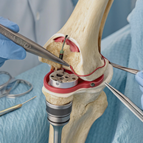 Knee replacement surgery in indore