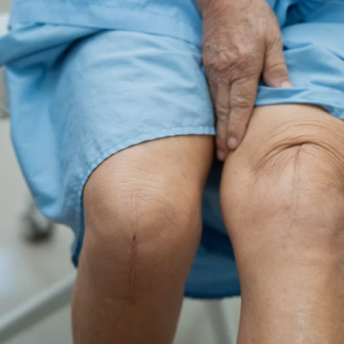 knee replacement surgery in Jaipur