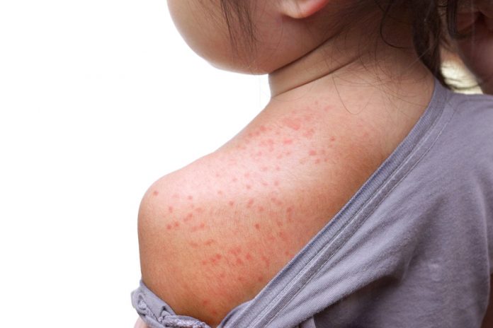 2nd measles case confirmed in Idaho – East Idaho Data