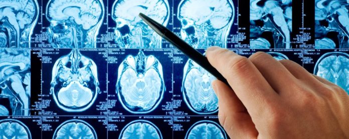 best neurologist in Chandigarh