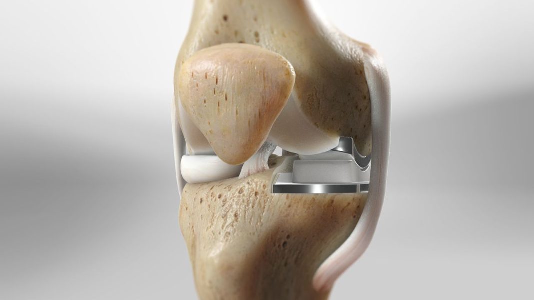 Best Partial Knee Replacement Surgeon in Mumbai