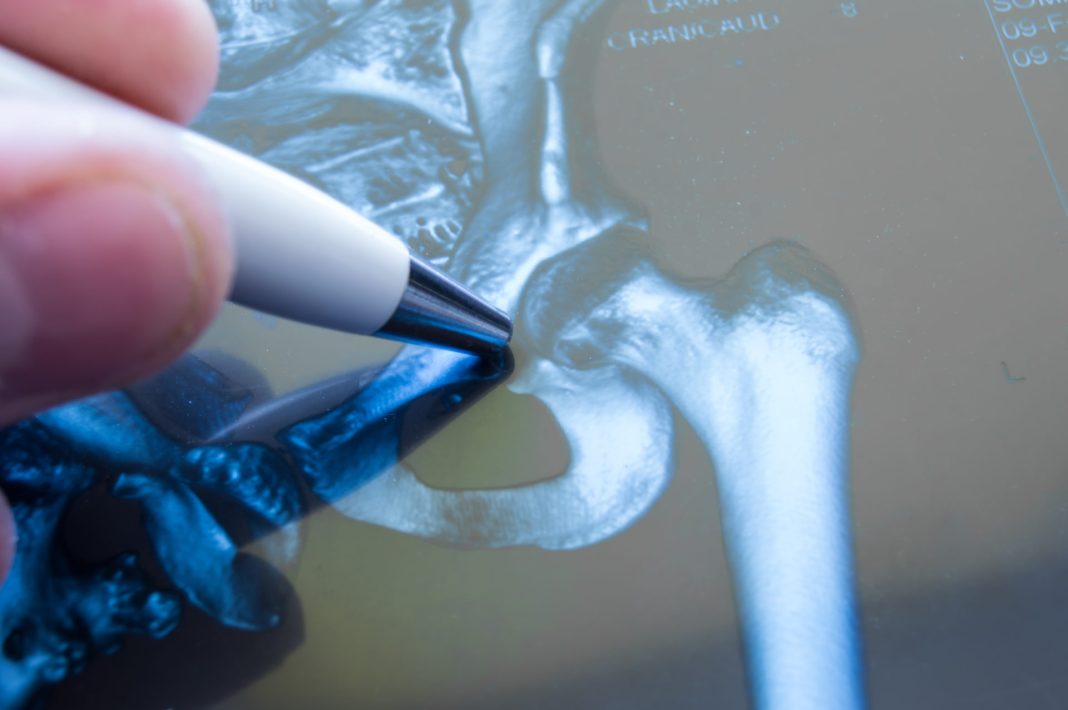 Best hip Replacement surgeon in Chandigarh