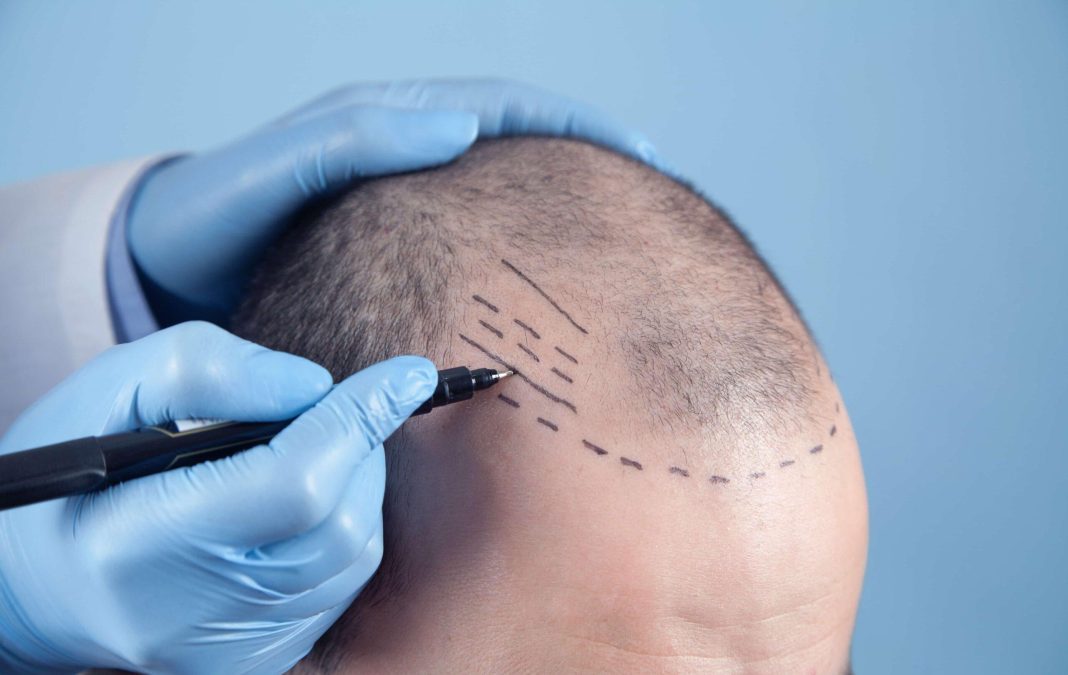 Best hair transplant in chandigarh