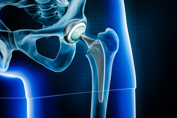 best hip replacement surgeon in Chandigarh