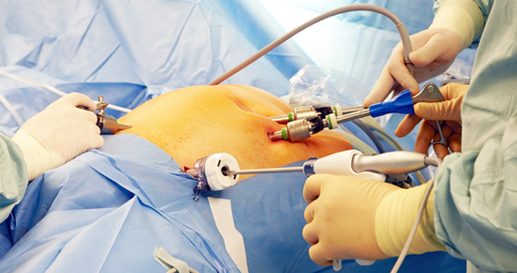 uterus removal expert in Mohali