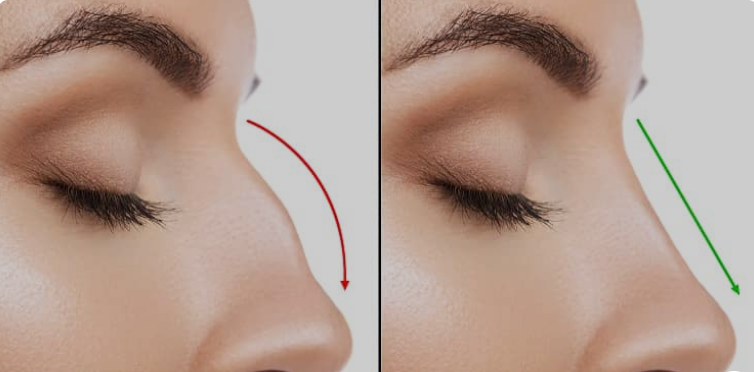 rhinoplasty in chandigarh 