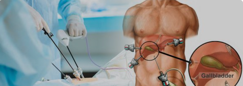 Laparoscopic Surgery in Mohali Expert Care and Modern Technology