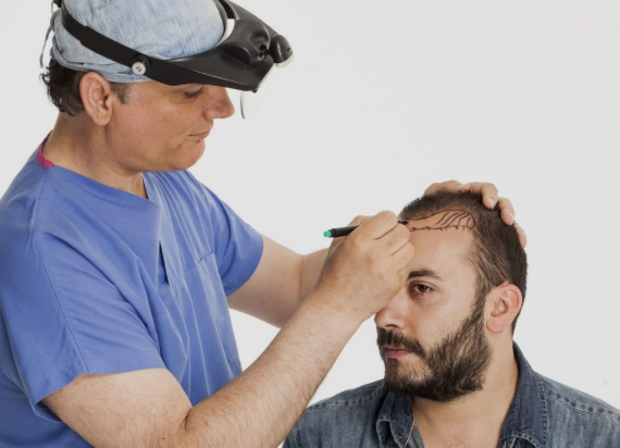 Best hair transplant in chandigarh