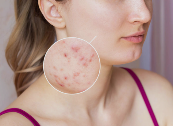 acne scar treatment in Chandigarh