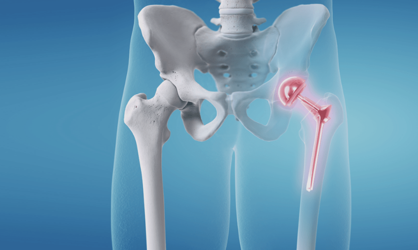 Hip Replacement Surgery in Chandigarh