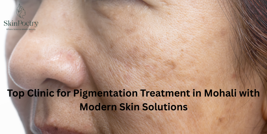 Pigmentation Treatment in Mohali