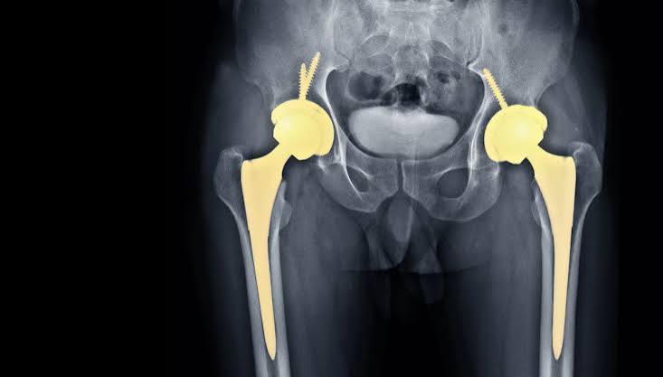 Total Hip Replacement in Chandigarh:
