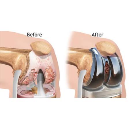 Knee Replacement Redo Surgery Chandigarh