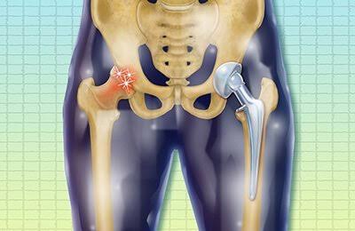 Hip Replacement Loosening Treatment Chandigarh